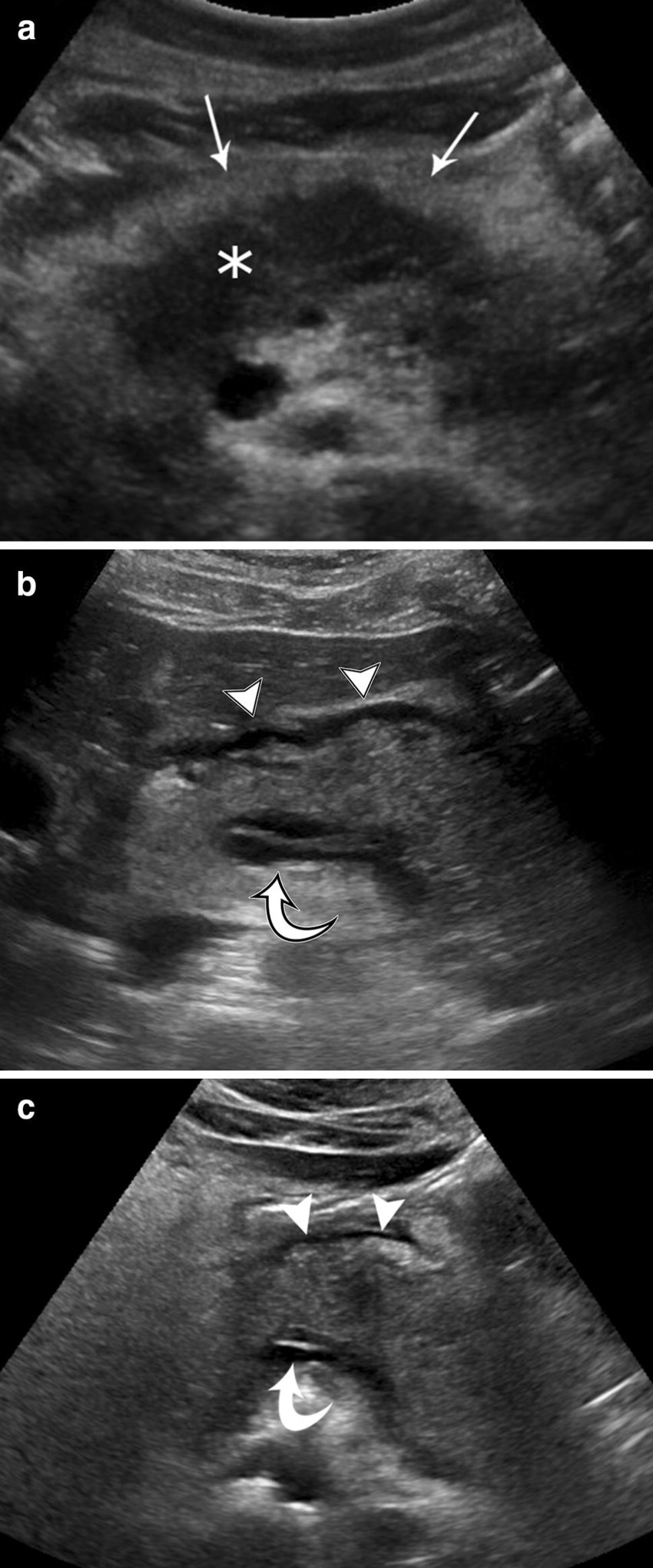 Gyulladás Gyulladás