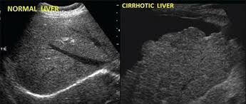 Cirhozis Cirhozis