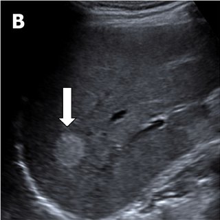Haemangioma Haemangioma