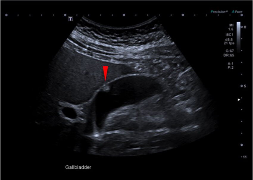 Epehólyag polyp Epehólyag polyp